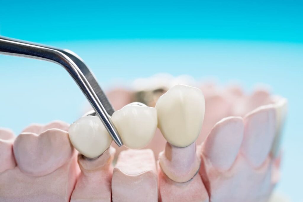 dental crowns rockhampton