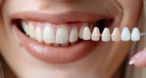 porcelain veneers rockhampton